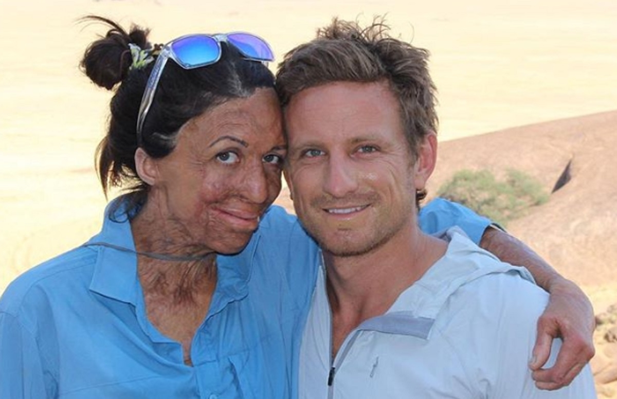 Une femme d�figur�e par un incendie re�oit la plus belle preuve d'amour de son mari