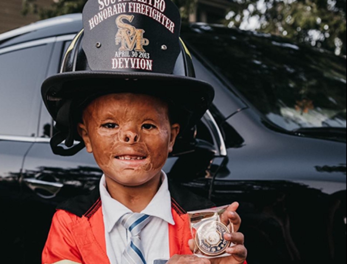 Un b�b� gri�vement brul� dans un incendie trouve finalement une famille apr�s 7 ans